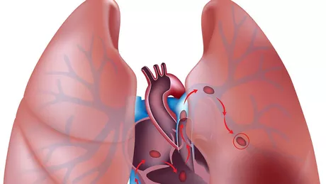 Ce este embolia pulmonară
