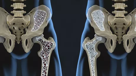 Osteoporoza cei 3 nutrienti esentiali pentru oase puternice
