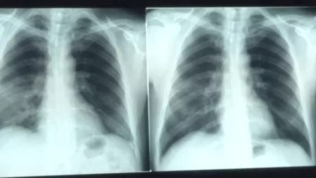 Covid-19 și leziunile pulmonare o formă deosebit de îngrijorătoare a bolii avertizează un pneumolog