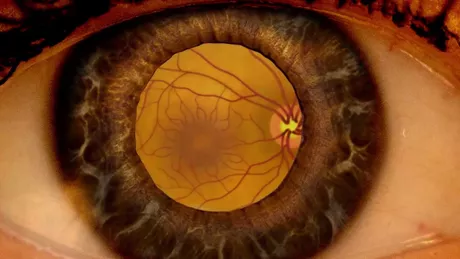 Descoperire promițătoare pentru pacienții cu retinopatie diabetică