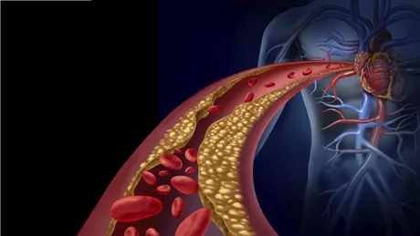 Tot ce ai vrut să știi despre colesterol