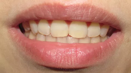 Îngrijirea dinților cei mai răi 6 dușmani ai dinților albi