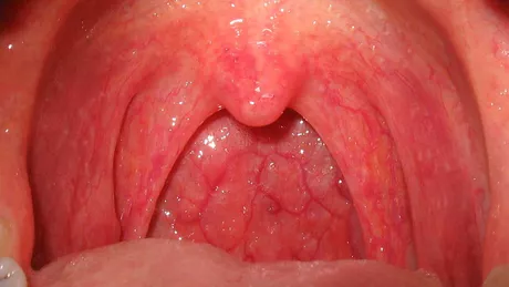 Cancerul gâtului simptome