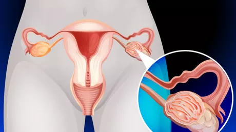 Dieta mediteraneană poate ajuta femeile care sufera de sindromul ovarului polichistic