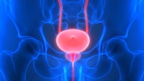 Cancerul vezicii urinare simptome și cauze