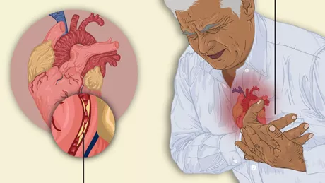 Ce simptome ai când faci infarct - 5 situații care atrag atenția