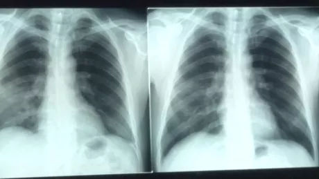 COVID-19 leziuni pulmonare prezente mult timp după infectare arată un studiu al Universitatii Oxford