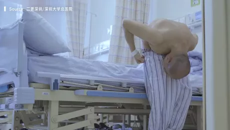 Un chinez a stat îndoit 28 de ani. Medicii au reuşit să-i îndrepte coloana după o operaţie chirurgicală complexă. Cum arată bărbatul acum - FOTO VIDEO