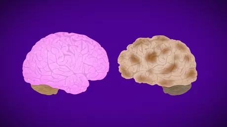 Boala Alzheimer canabisul ar putea îmbunătăți abilitățile cognitive