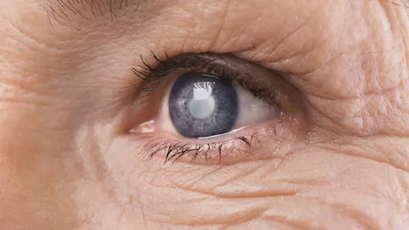 4 concepții greșite despre cataractă