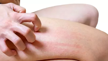 Ce boli ascunde mâncărimea de piele Mare atenție la ce este în spatele pruritului