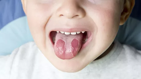 Cum se tratează aftele bucale la copii. Din ce cauze apar acestea