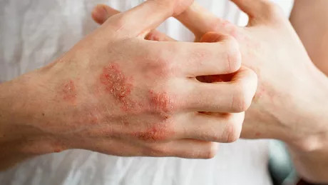 Cele mai bune leacuri bătrânești pentru eczeme Cum să le tratezi folosind remedii naturale
