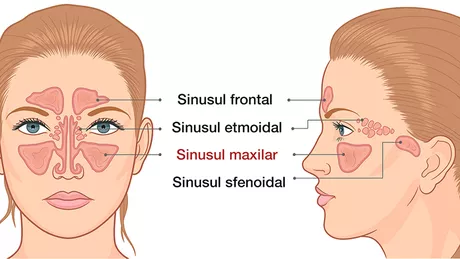 Sinuzita cronică - Principalele simptome ale acestei afecțiuni. Cum poate fi tratată