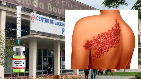 Semnal de alarmă venit de la Iași Apar afecțiuni grave după administrarea vaccinului anti COVID-19 O persoană a venit în a 6-a zi după rapel și prezenta zona zoster