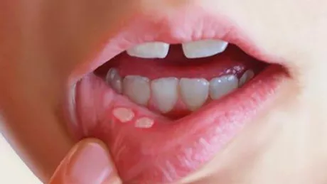 Afte bucale Tratament simplu și eficient cu bicarbonat de sodiu
