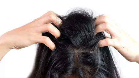 Dermatită seboreică scalp Tratamentul recomandat de specialiști