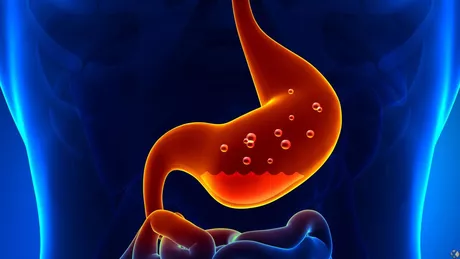 Criza de gastrită simptome - Cum se manifestă această afecțiune