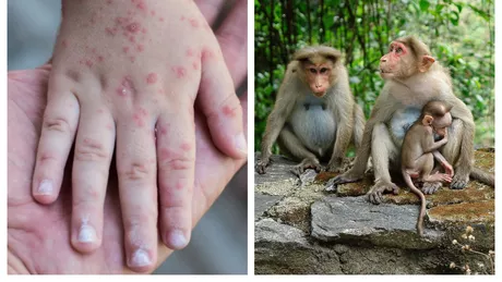 Cazurile de variola maimuței au crescut Autoritățile sunt în alertă