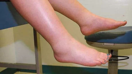 Tratament pentru picioare umflate și vinete. Ce recomandă medicii