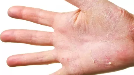 Poze eczeme pe mâini. Metode de tratament în funcție de tipul de vezicule apărute pe membre
