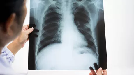 Ce înseamnă opacitate pulmonară Iată la ce se referă termenul și cum se clasifică