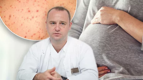 Caz rar la Iași O pacientă însărcinată infectată cu varicelă la Spitalul de Boli Infecțioase