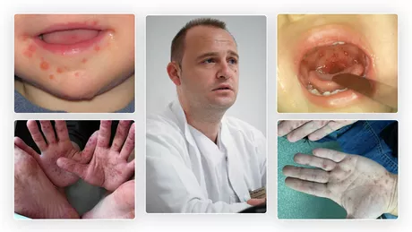 Mână-gură-picior boala care îi înspăimântă pe părinți Dr. Florin Roșu Pacientul va putea contracta în continuare boala deoarece serotipurile Coxsackie sunt numeroase