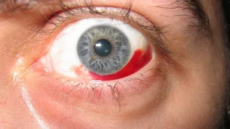 Ochi inundat de sânge. Cauze și tratament pentru hemoragia subconjunctivală