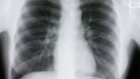 Ce este radiografia la plămâni Află cum se realizează și când este recomandată