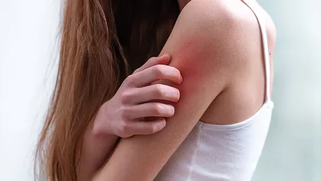 Alergii ale pielii-poze. Ce substanțe cauzează o astfel de problemă de sănătate