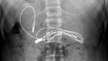 Medicii au crezut că nu văd bine Ce gadget au putut găsi în stomacul unui adolescent care acuza dureri de burtă