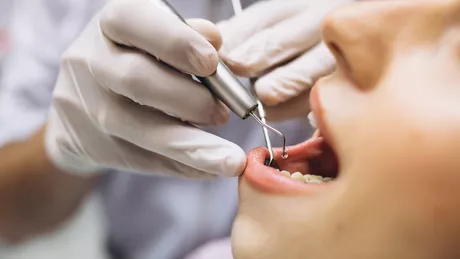 Detartrajul sensibilizează dinții Explicația medicului Andreea Daniela Alexe - VIDEO