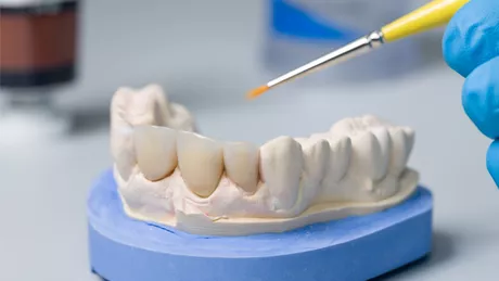 5 motive pentru care să optezi pentru o coroană dentară