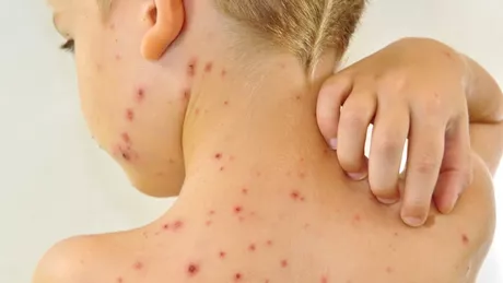 Erupție provocată de scarlatină  poze. Ce complicații grave poate provoca afecțiunea dermatologică