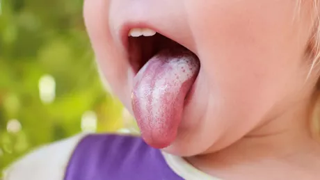 Cum putem trata candidoza bucală la bebeluși