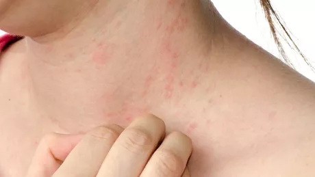 Iritații ale pielii  poze. Ce afecțiuni pot provoca astfel de probleme dermatologice