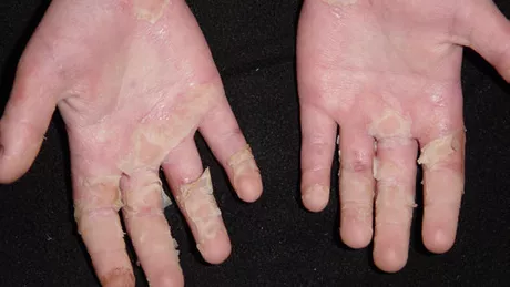 Exfoliere piele mâini. Ce vitamină lipsa o cauzează și cum poate fi tratată această problemă
