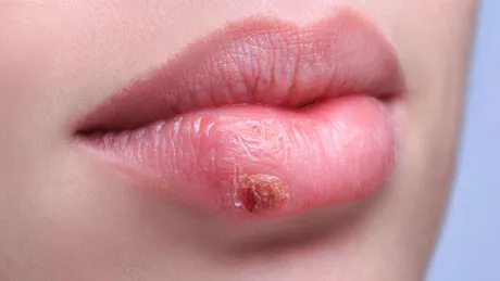 Scapă de herpes în câteva ore. 5 metode simple și testate de specialiști