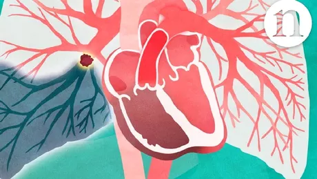 Ce înseamnă dacă ai trombembolism pulmonar Iată cauze și modalități de tratament