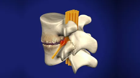 Rețetă minune pentru vindecarea spondilozei cervicale. Cum poți preveni reapariția afecțiunii