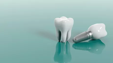 Poți muri de la un implant dentar Care sunt riscurile asociate