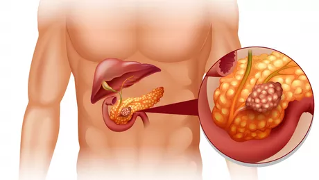 Tipuri de enzime pancreatice. În ce cazuri este recomandată administrarea acestora