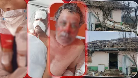 A vrut să-și facă o cafea dar asta i-a nenorocit soțul pe viață Bărbatul a ajuns cu arsuri grave la Spitalul Sf. Spiridon Când a aprins becul butelia a explodat - FOTOVIDEO