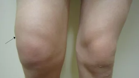 De ce facem apa la genunchi care sunt simptomele si cum tratam aceasta problema