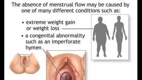 Amenoreea sau lipsa menstruatiei - GALERIE FOTO