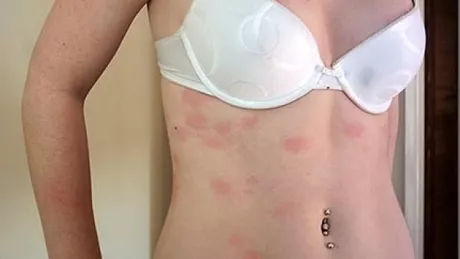 Top 12 alergii bizare