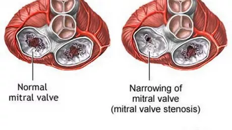 Stenoza mitrala. Cauze si simptome