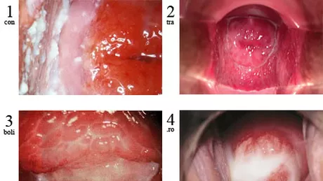 Infectiile care afecteaza 75 dintre femei Putine stiu insa asta
