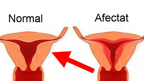 Menstruatia abundenta cauze si tratament
